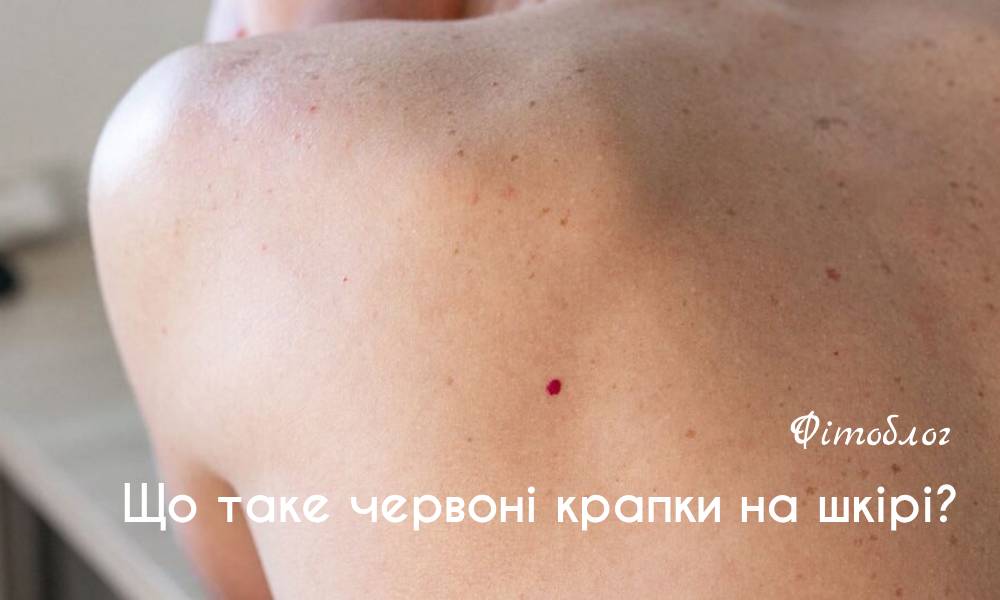 Червоні точки на тілі: причини появи та коли варто звернутися до лікаря